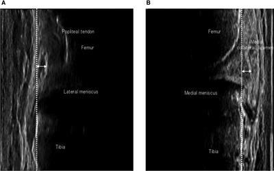 Temporary meniscus extrusion is caused by cumulative stress from uphill and downhill tasks in healthy volunteers